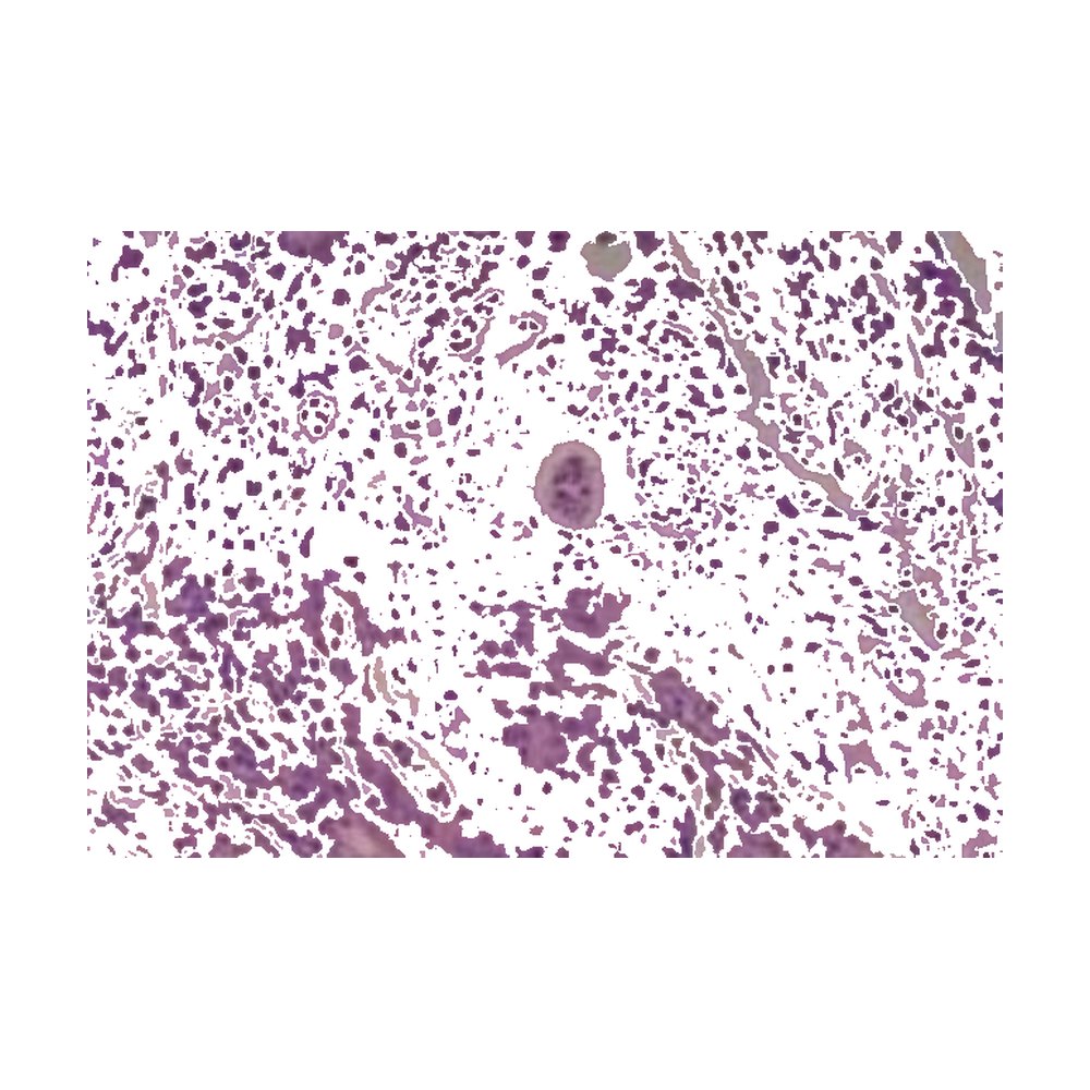 Novus Biologicals&trade;&nbsp;Micro-réseau de tissus (TMA) humains multi-tissus (cancer)